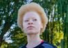 International Albinism Awareness Day 2025: People with Albinism Still Face Discrimination