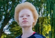 International Albinism Awareness Day 2025: People with Albinism Still Face Discrimination