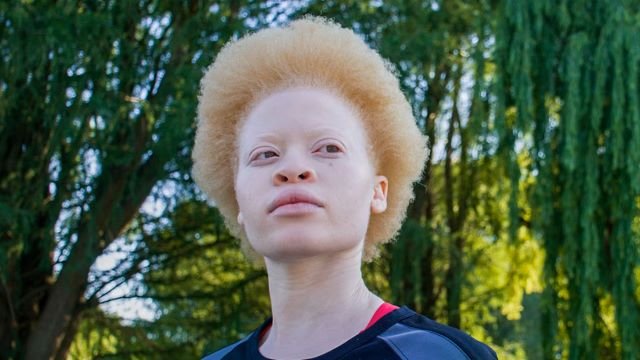 International Albinism Awareness Day 2025: People with Albinism Still Face Discrimination