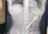 A Woman in Belgium Accidentally Swallows 17cm Spoon