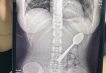 A Woman in Belgium Accidentally Swallows 17cm Spoon